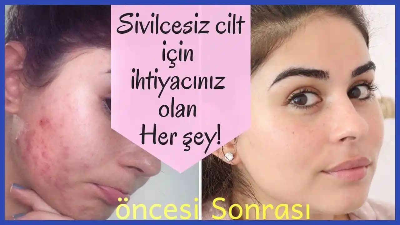 Hormonal Akne Tedavisinde Yeni Yaklaşımlar ve Zihinsel Sağlığın Rolü