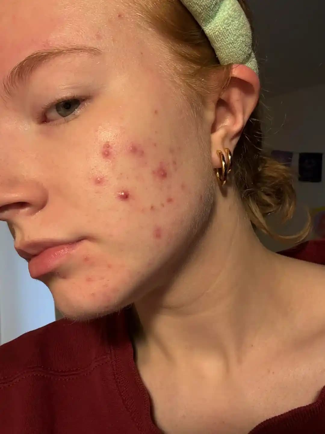 Hormonal Akne Tedavisinde Etkili Yöntemler ve Kapsamlı Tedavi Seçenekleri