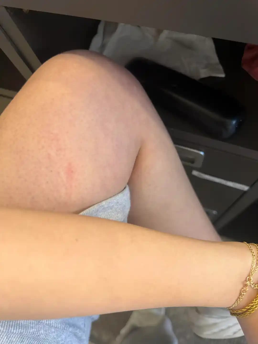 Çilek Bacaklar (Keratosis Pilaris) İçin Etkili Bakım Yöntemleri ve Ürün Önerileri