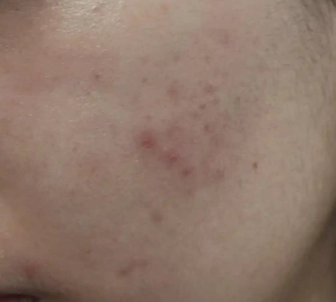 Differin (Adapalene) Kullanımında Akne Tedavisi Zorlukları ve Çözüm Yöntemleri