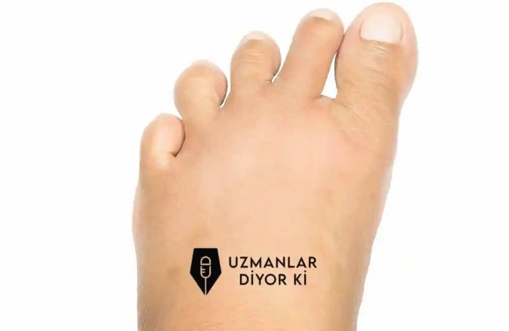 Ayak Pişiği Nedenleri, Belirtileri ve Etkili Önleme ile Tedavi Yöntemleri