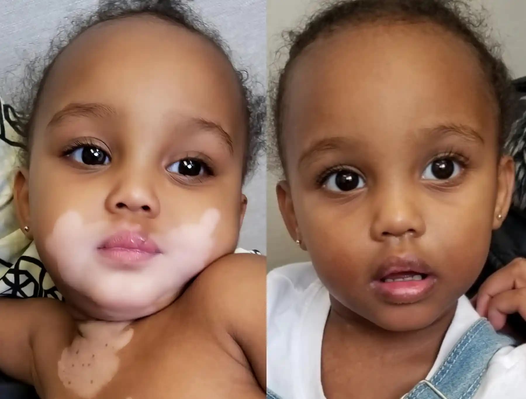 Bebeklerde Vitiligo: Belirtileri, Tanısı, Tedavisi ve Etkili Bakım Yöntemleri