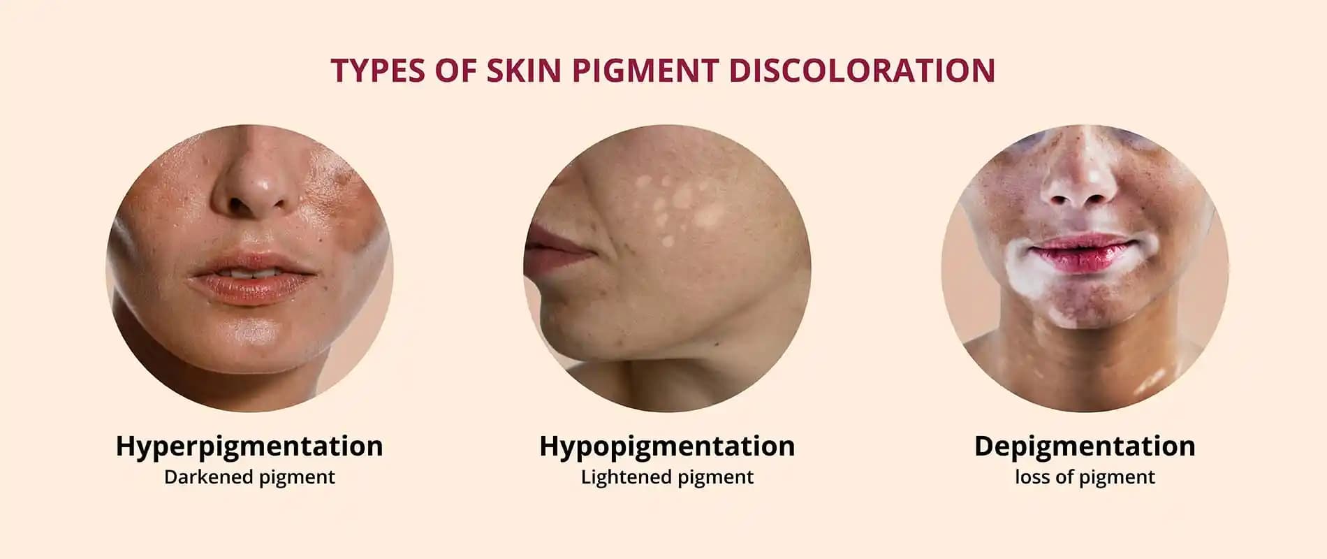 Pigment Eksikliği ve Melanin: Cilt Sağlığı ve Güzellik Bakımında Önemi