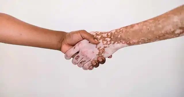 Vücutta Beyaz Lekeler: Nedenleri, Teşhisi, Tedavisi ve Güzellik Bakımı